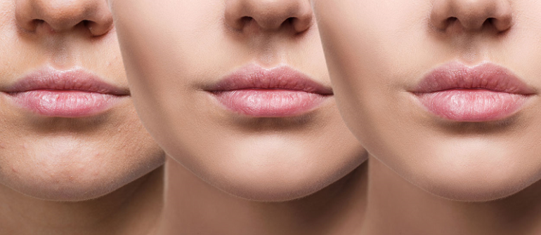 تزریق چربی لب با چه هدفی صورت می پذیرد ؟