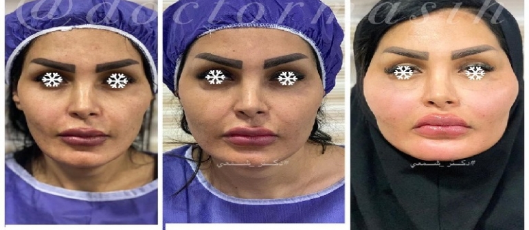 ترمیم تزریق چربی صورت