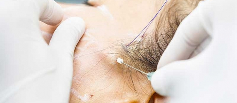 لیفت با نخ PDO چگونه کار می کند؟