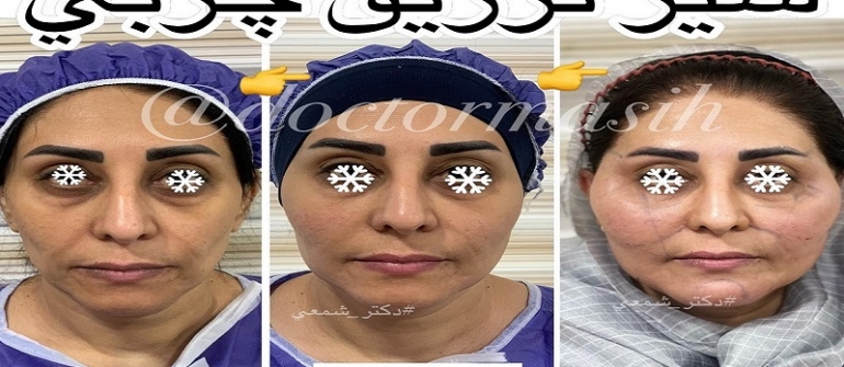 سیر تزریق چربی در کل صورت