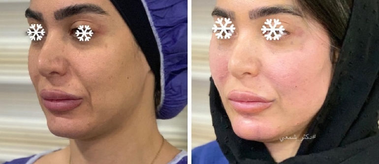 تزریق چربی صورت برای خانم ها