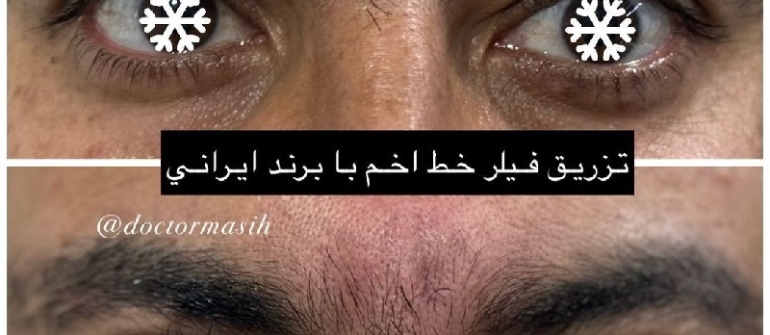 بوتاکس صورت در آقایان
