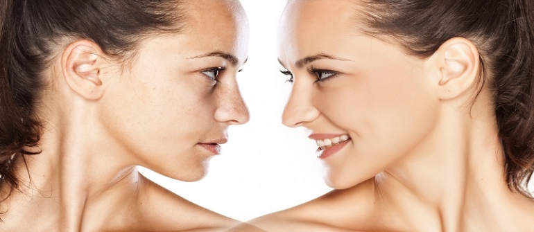 پیوند چربی صورت از نمونه کارهای زیبایی دکتر مسیح شمعی