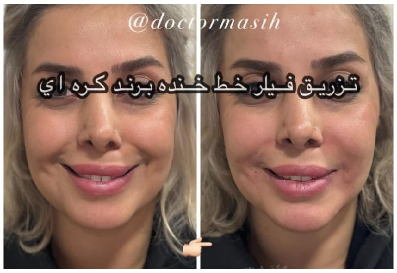 تزریق فیلر خط خنده با برند کره ای