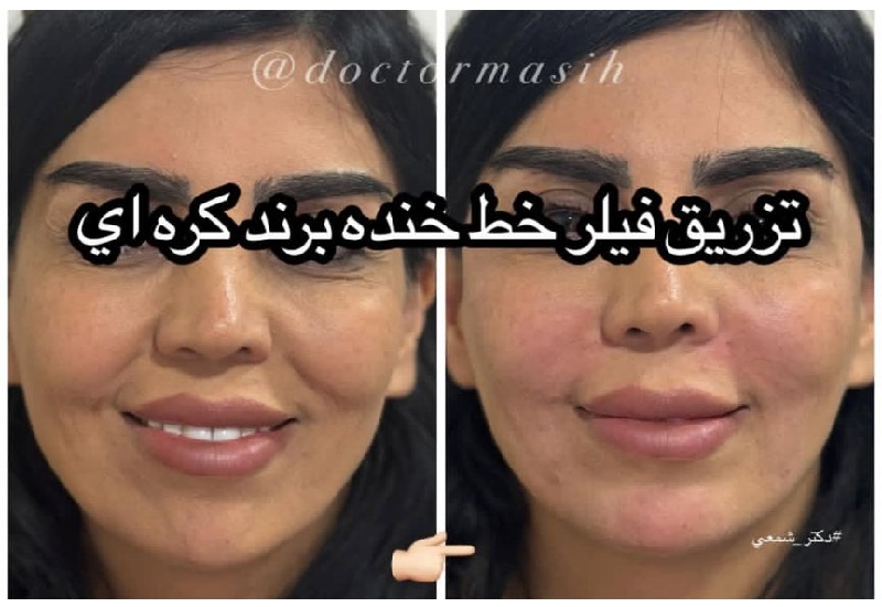 تزریق فیلر خط خنده با برند کره ای