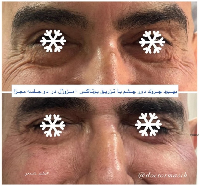 جوانسازی دور و زیر چشم