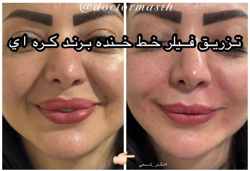 تزریق فیلر خط خنده با برند کره ای