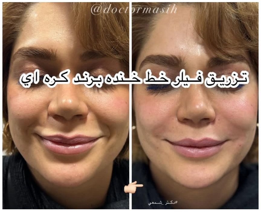 تزریق فیلر خط خنده با برند کره ای