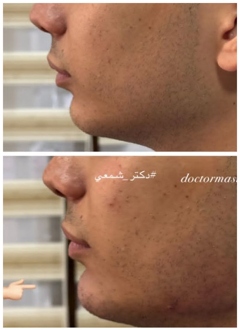تزریق فیلر چانه و اصلاح فرم