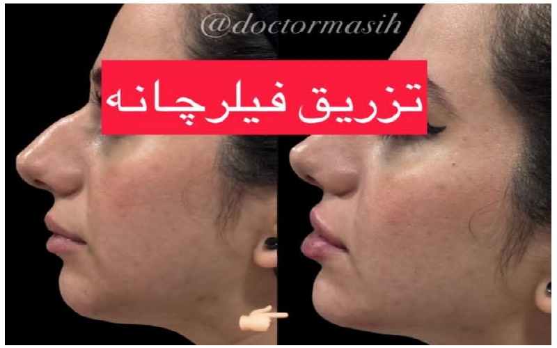 تزریق فیلر چانه و اصلاح فرم