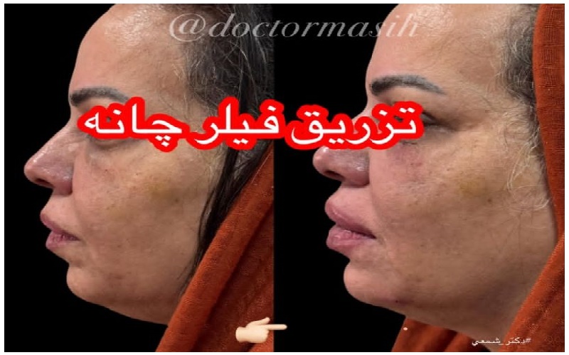 تزریق فیلر چانه و اصلاح فرم