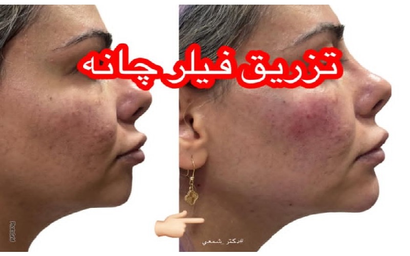 تزریق فیلر چانه و اصلاح فرم