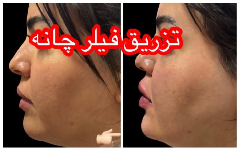 تزریق فیلر چانه و اصلاح فرم