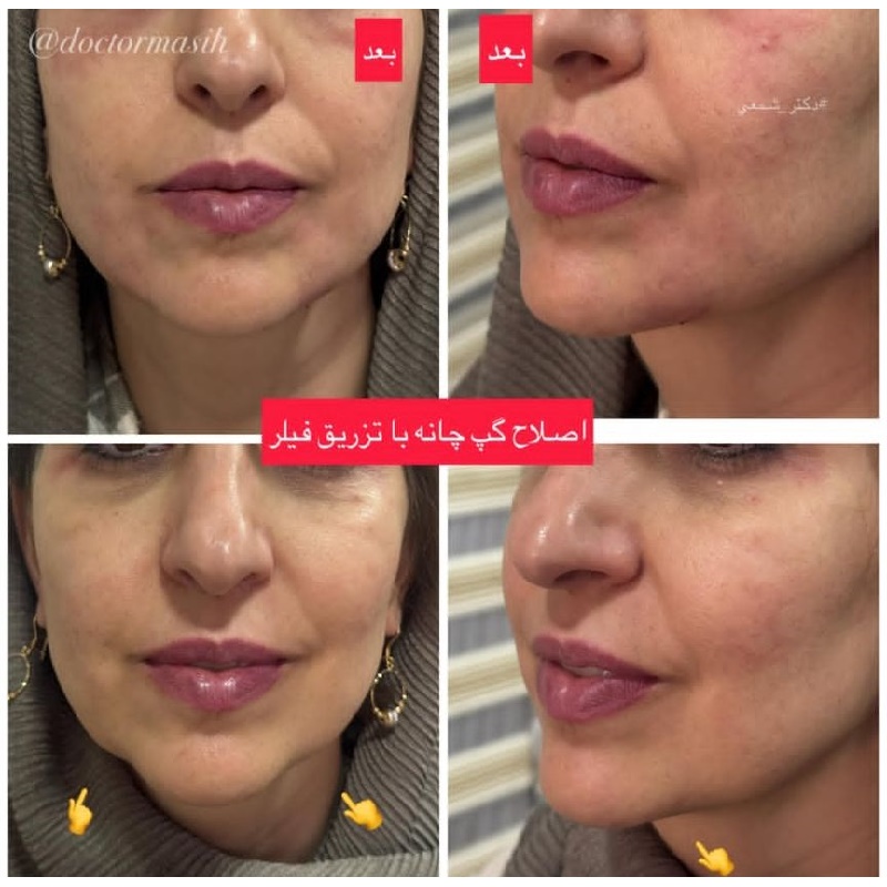 تزریق فیلر چانه و اصلاح فرم