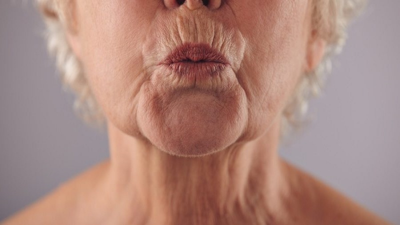 بوتاکس دور دهان : چگونه بدون تغییر حالت لب و صورت، خط را کنترل کنیم؟