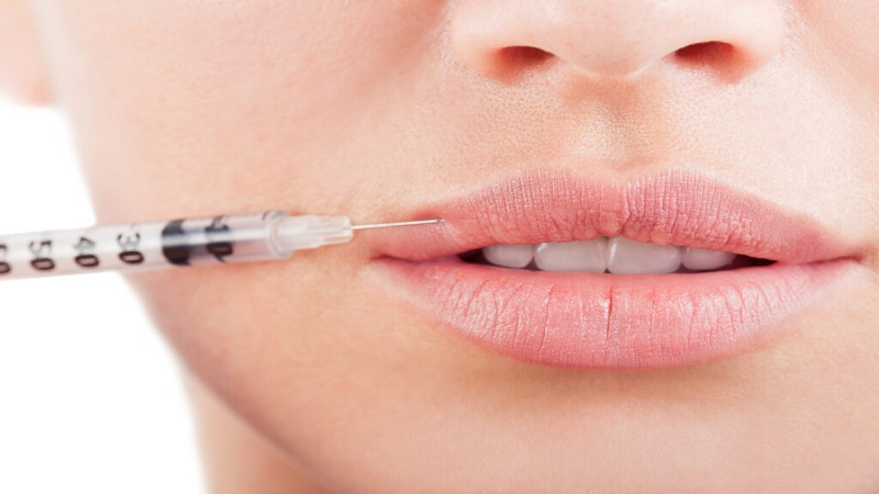 بوتاکس دور دهان : چگونه بدون تغییر حالت لب و صورت، خط را کنترل کنیم؟